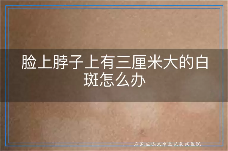 脸上脖子上有三厘米大的白斑怎么办