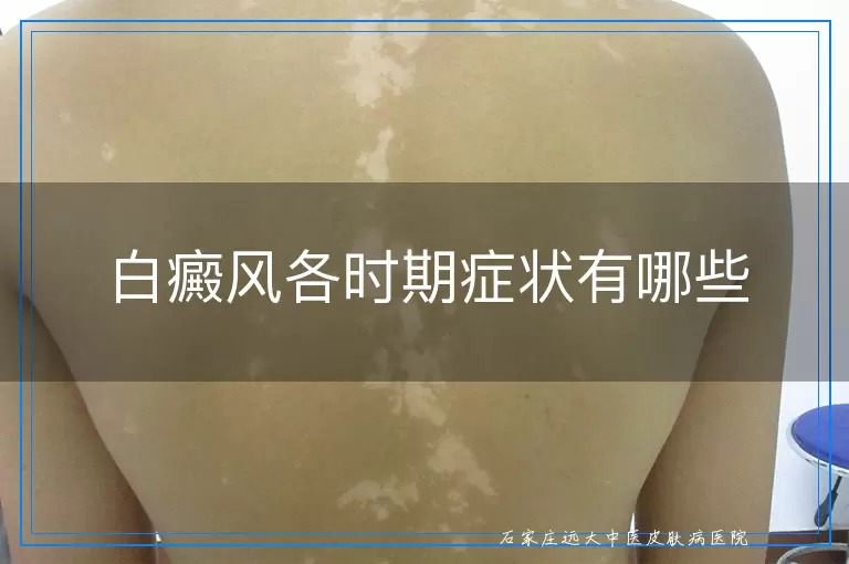 白癜风各时期症状有哪些
