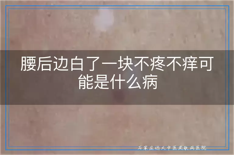 腰后边白了一块不疼不痒可能是什么病
