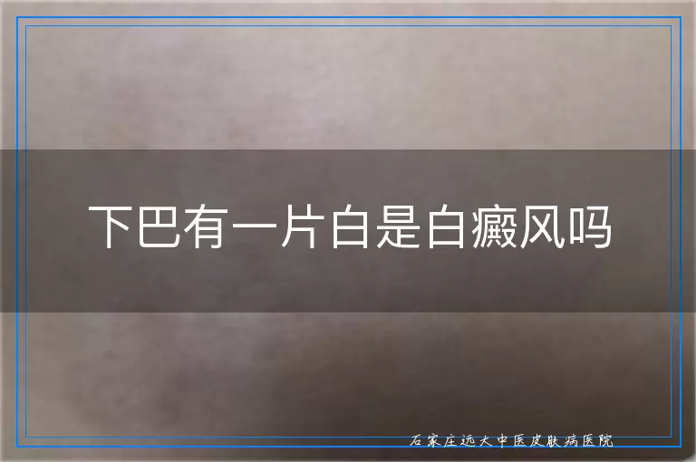 下巴有一片白是白癜风吗