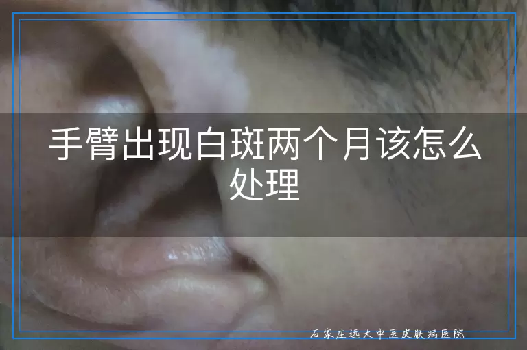 手臂出现白斑两个月该怎么处理