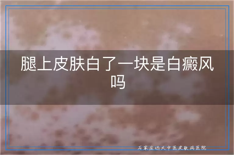 腿上皮肤白了一块是白癜风吗