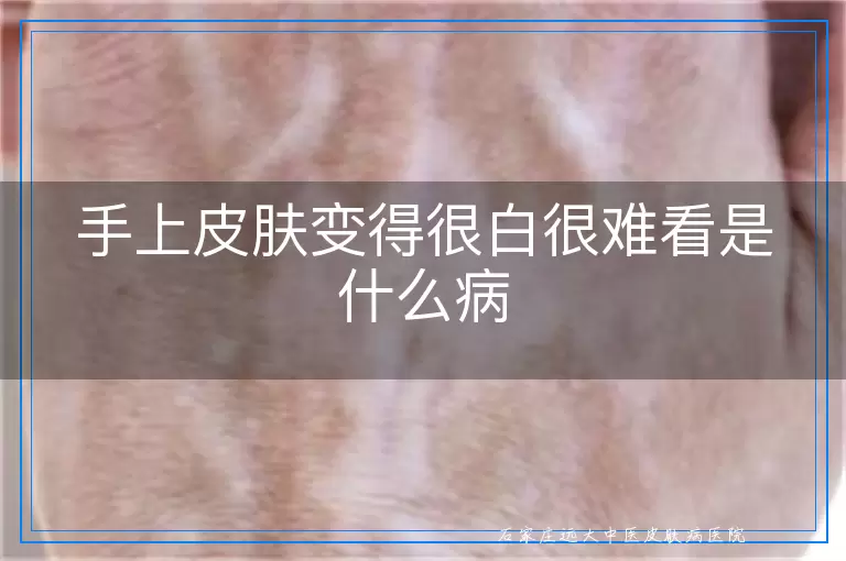 手上皮肤变得很白很难看是什么病