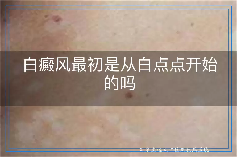 白癜风最初是从白点点开始的吗