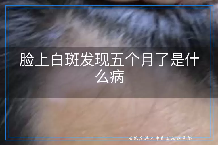 脸上白斑发现五个月了是什么病