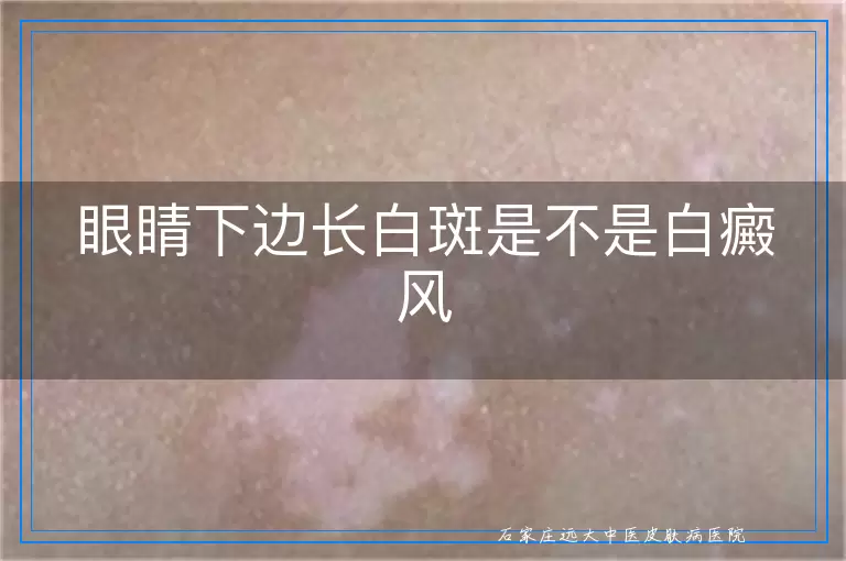眼睛下边长白斑是不是白癜风