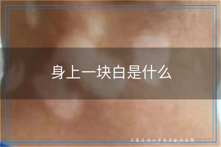 身上一块白是什么