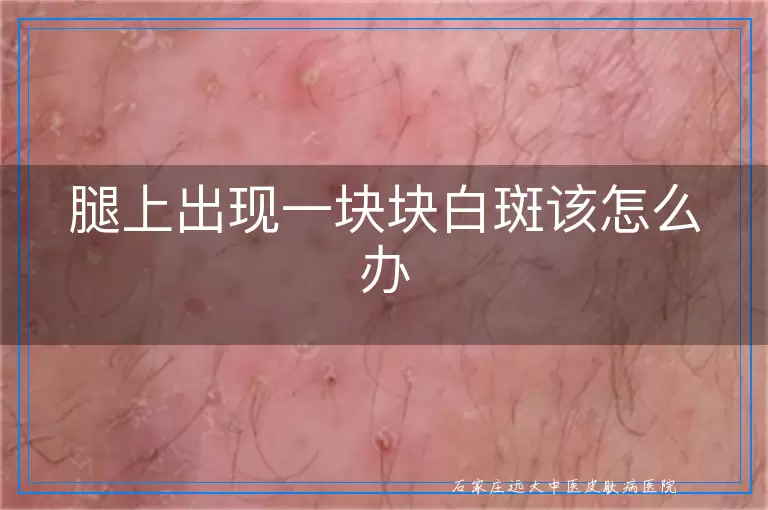 腿上出现一块块白斑该怎么办