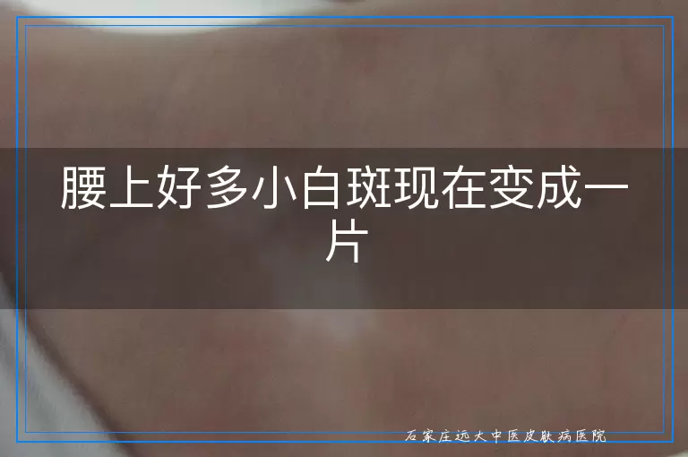 腰上好多小白斑现在变成一片