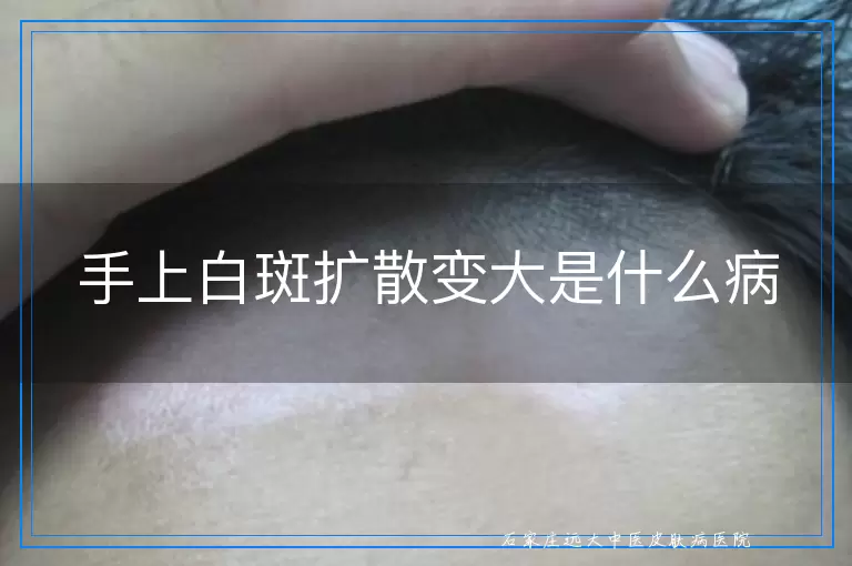 手上白斑扩散变大是什么病