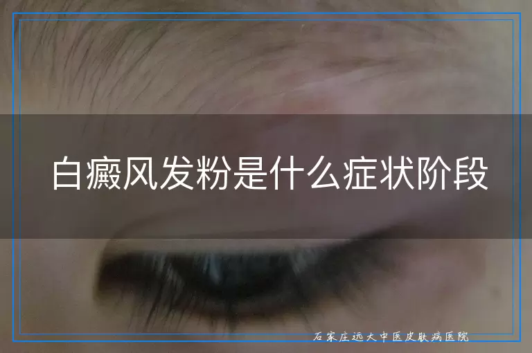 白癜风发粉是什么症状阶段