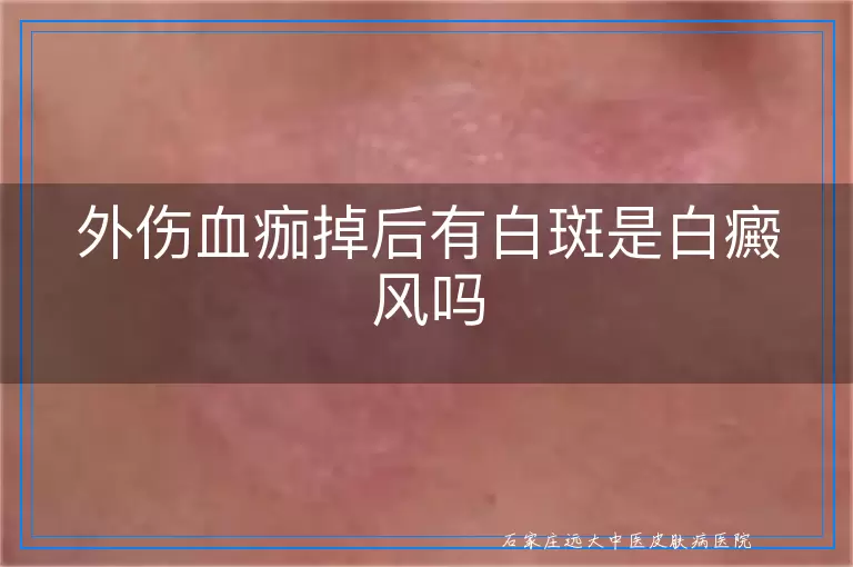 外伤血痂掉后有白斑是白癜风吗