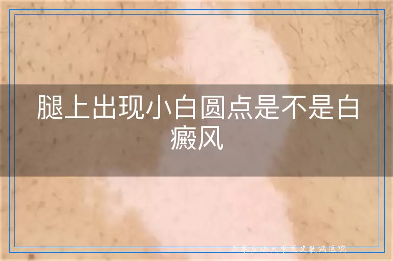 腿上出现小白圆点是不是白癜风
