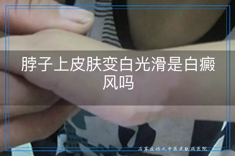 脖子上皮肤变白光滑是白癜风吗