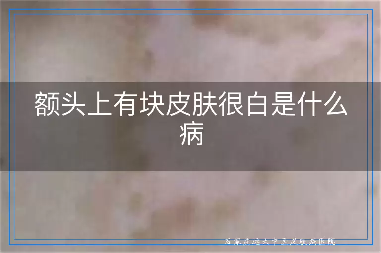额头上有块皮肤很白是什么病