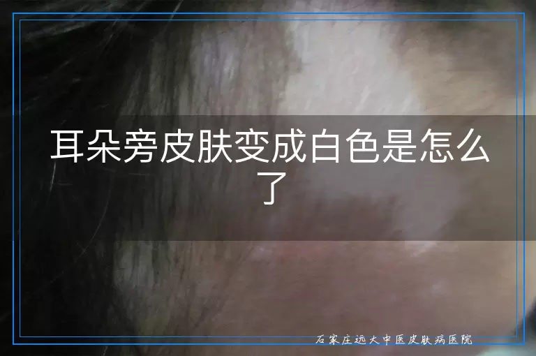 耳朵旁皮肤变成白色是怎么了