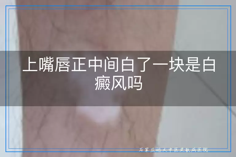 上嘴唇正中间白了一块是白癜风吗