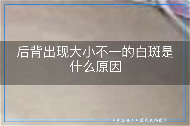 后背出现大小不一的白斑是什么原因