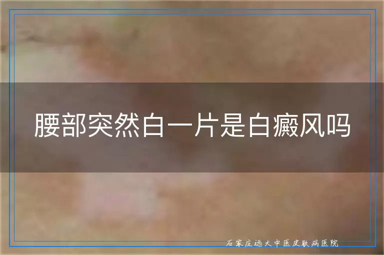 腰部突然白一片是白癜风吗