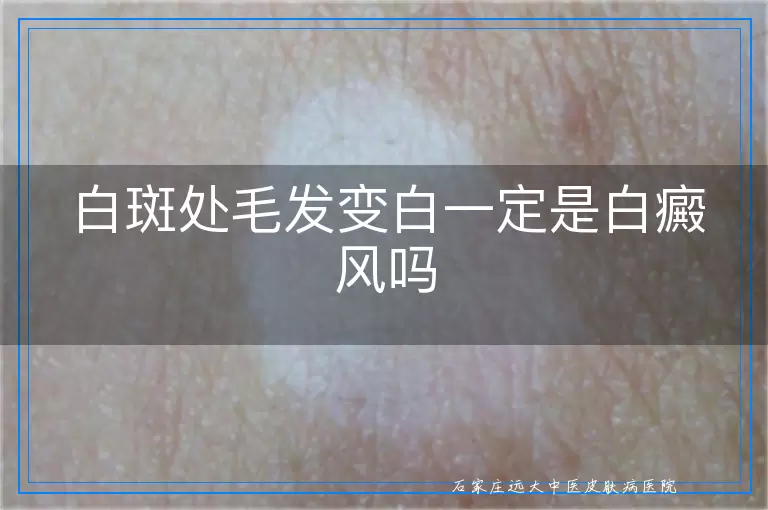 白斑处毛发变白一定是白癜风吗