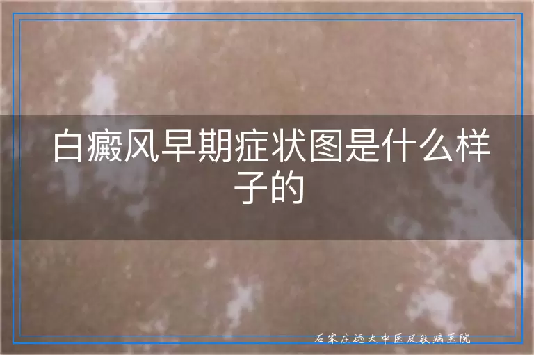 白癜风早期症状图是什么样子的