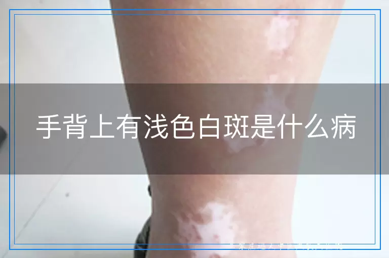 手背上有浅色白斑是什么病
