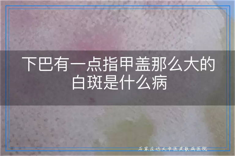下巴有一点指甲盖那么大的白斑是什么病