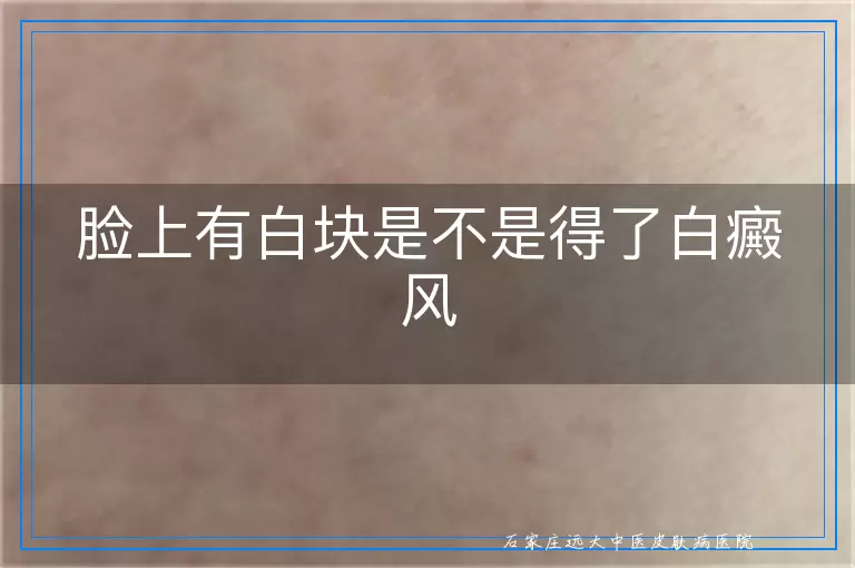 脸上有白块是不是得了白癜风