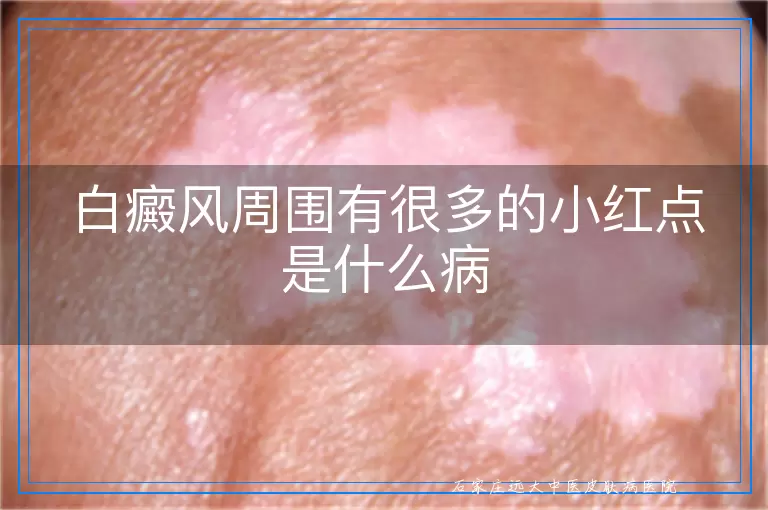 白癜风周围有很多的小红点是什么病