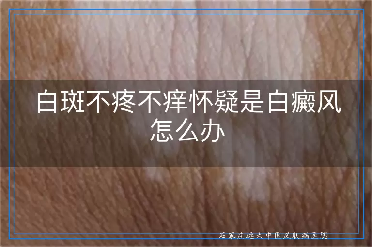 白斑不疼不痒怀疑是白癜风怎么办