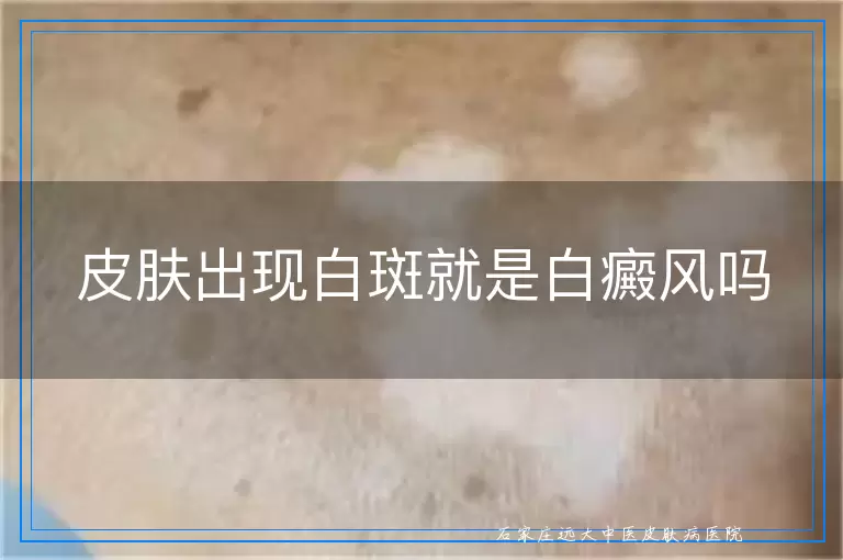 皮肤出现白斑就是白癜风吗