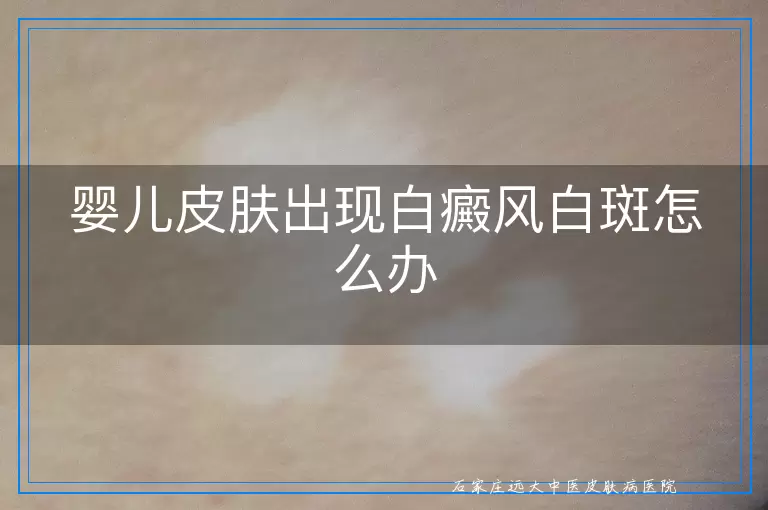 婴儿皮肤出现白癜风白斑怎么办