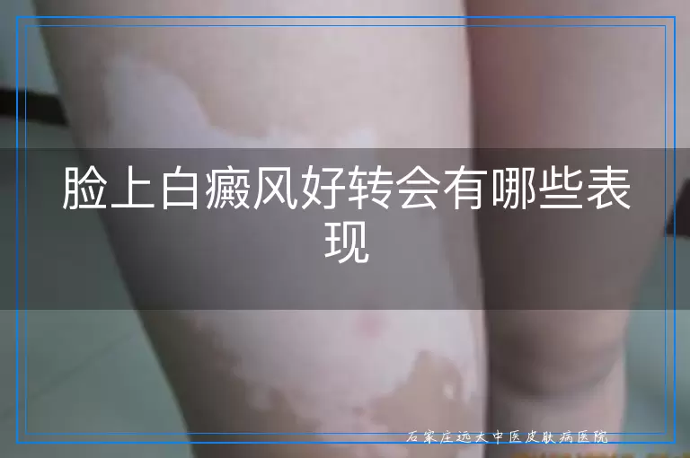 脸上白癜风好转会有哪些表现