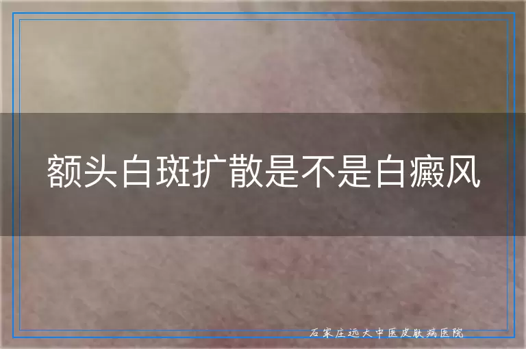 额头白斑扩散是不是白癜风
