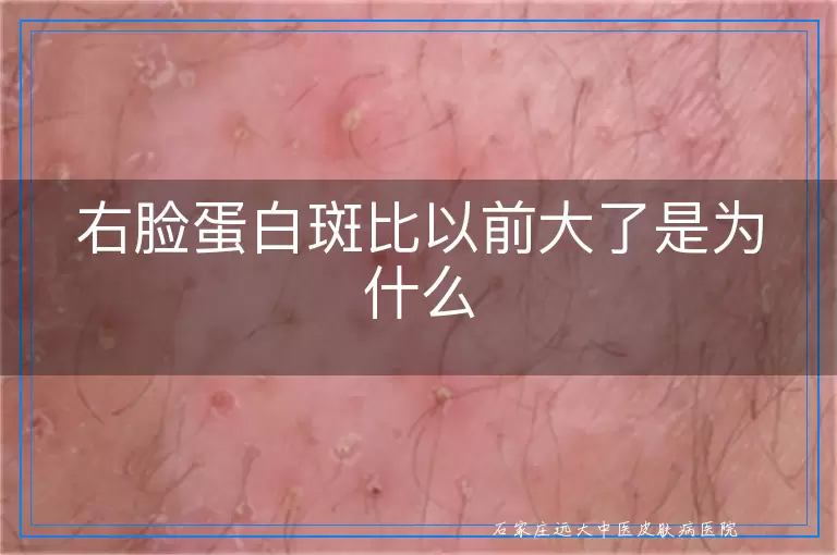 右脸蛋白斑比以前大了是为什么