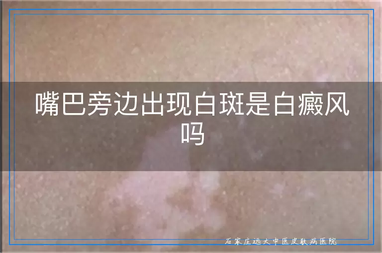 嘴巴旁边出现白斑是白癜风吗