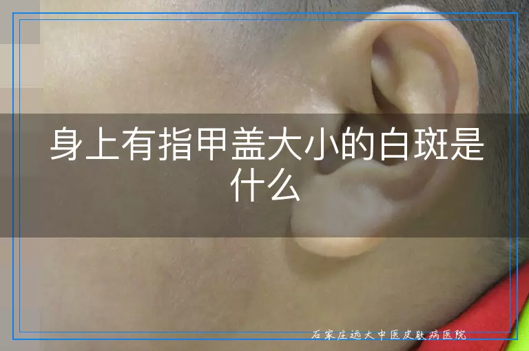 身上有指甲盖大小的白斑是什么