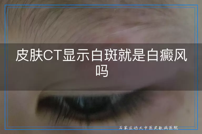 皮肤CT显示白斑就是白癜风吗