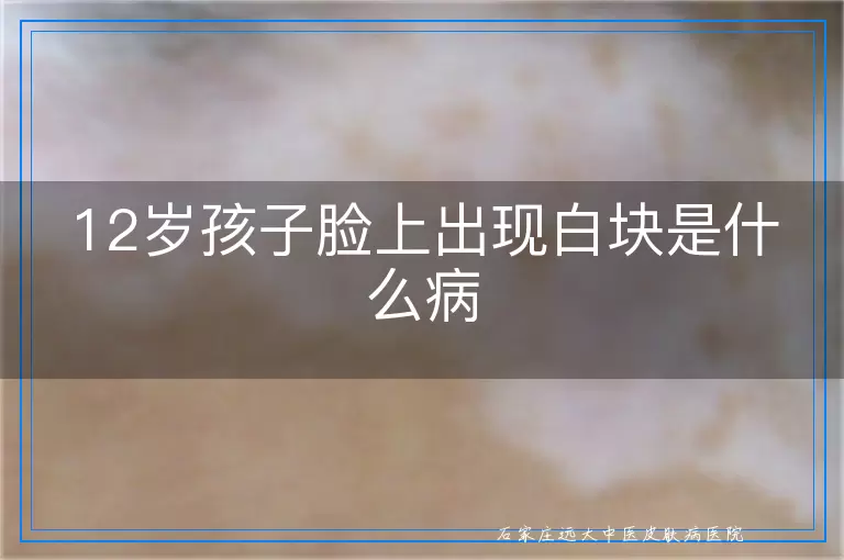 12岁孩子脸上出现白块是什么病