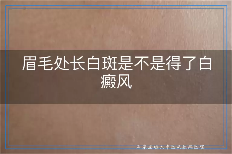 眉毛处长白斑是不是得了白癜风