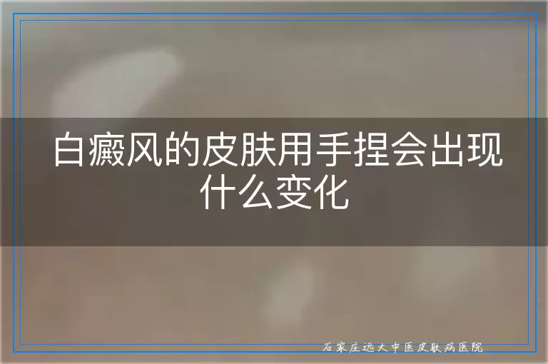 白癜风的皮肤用手捏会出现什么变化