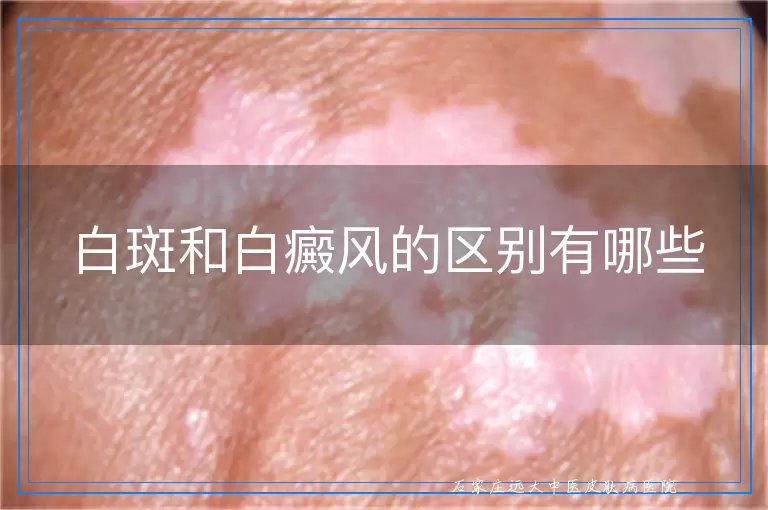 白斑和白癜风的区别有哪些