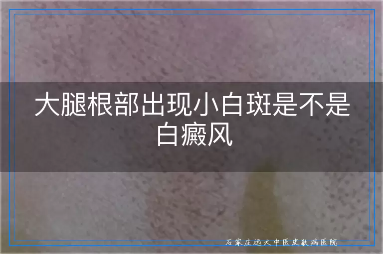 大腿根部出现小白斑是不是白癜风