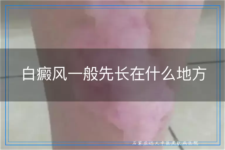 白癜风一般先长在什么地方