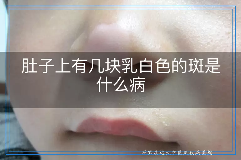 肚子上有几块乳白色的斑是什么病
