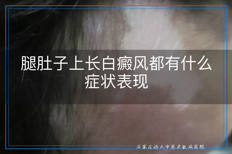 腿肚子上长白癜风都有什么症状表现
