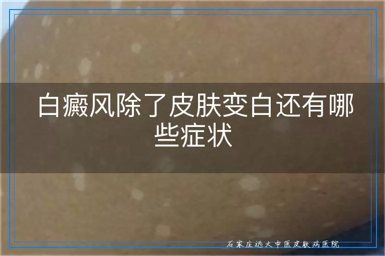白癜风除了皮肤变白还有哪些症状