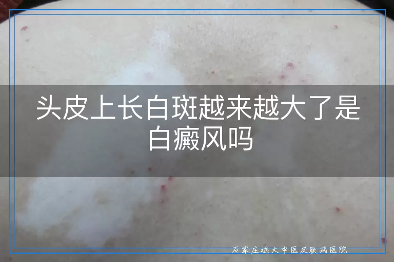 头皮上长白斑越来越大了是白癜风吗