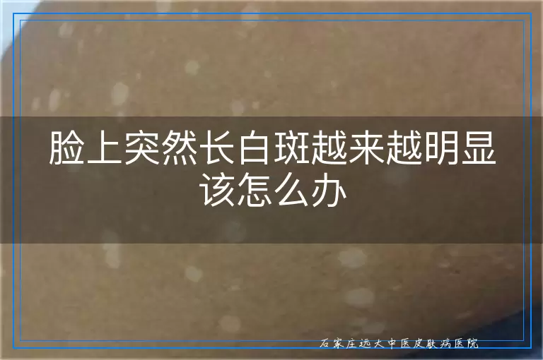 脸上突然长白斑越来越明显该怎么办