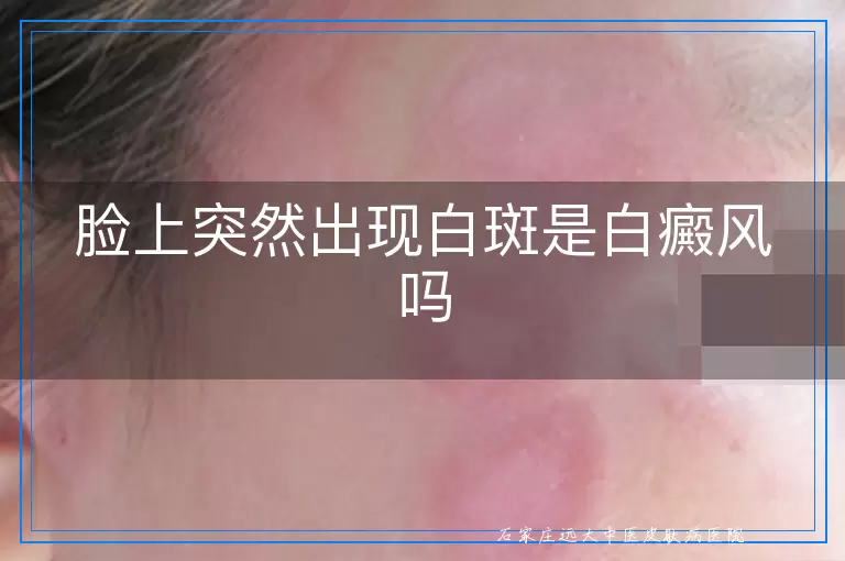 脸上突然出现白斑是白癜风吗